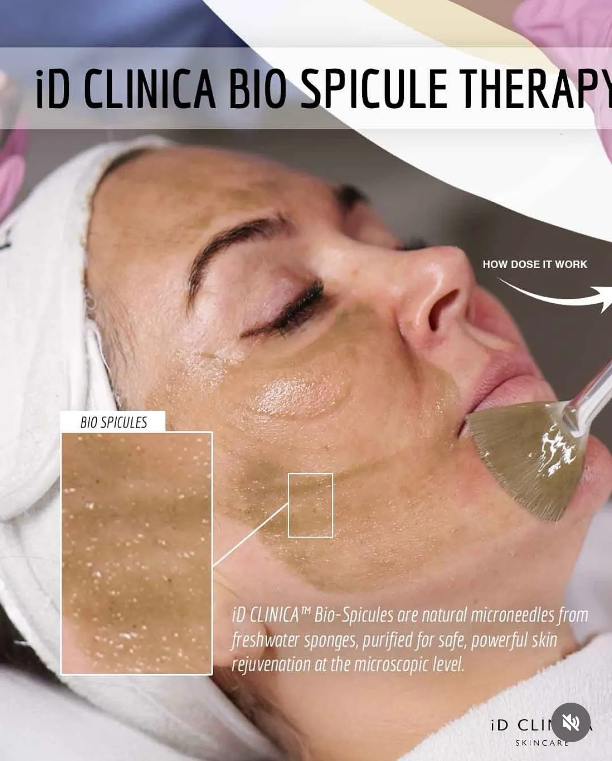 BioSpicules for Reactive Skin Acne Pigmentation and Rosacea 2 BioSpicules for Reactive Skin Acne Pigmentation and Rosacea