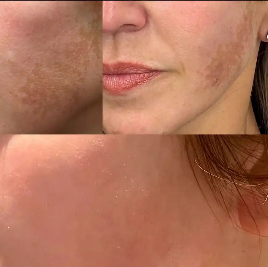 Chemical Peels