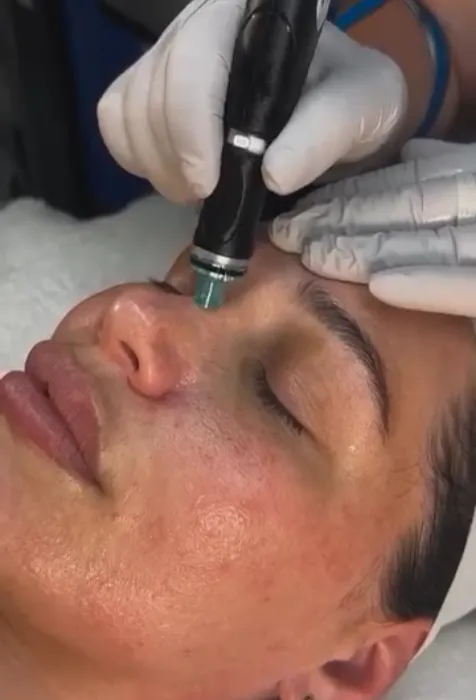 Hydrafacial – The Treatment Your Skin Secretly Wants 1 Advanced facial treatment