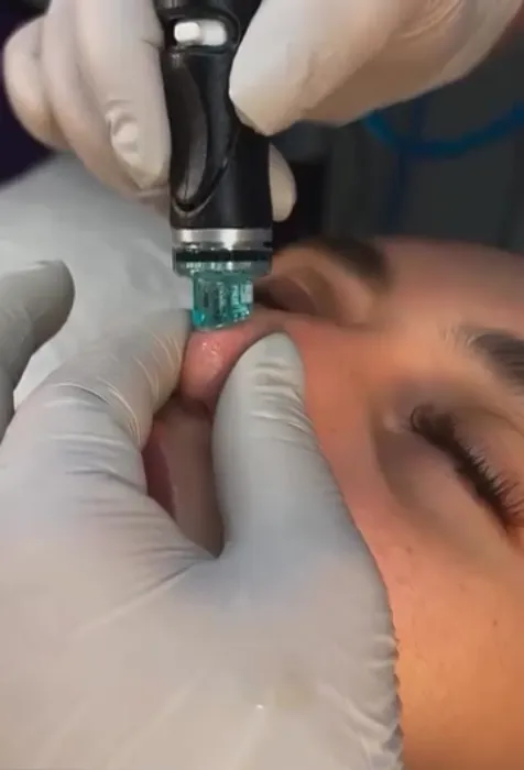 Hydrafacial – The Treatment Your Skin Secretly Wants 2 deep cleaning facial