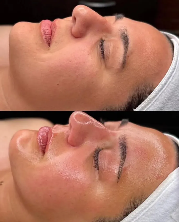 Hydrafacial vs Sculptra